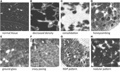 Optimization Strategies for Interactive Classification of Interstitial Lung Disease Textures